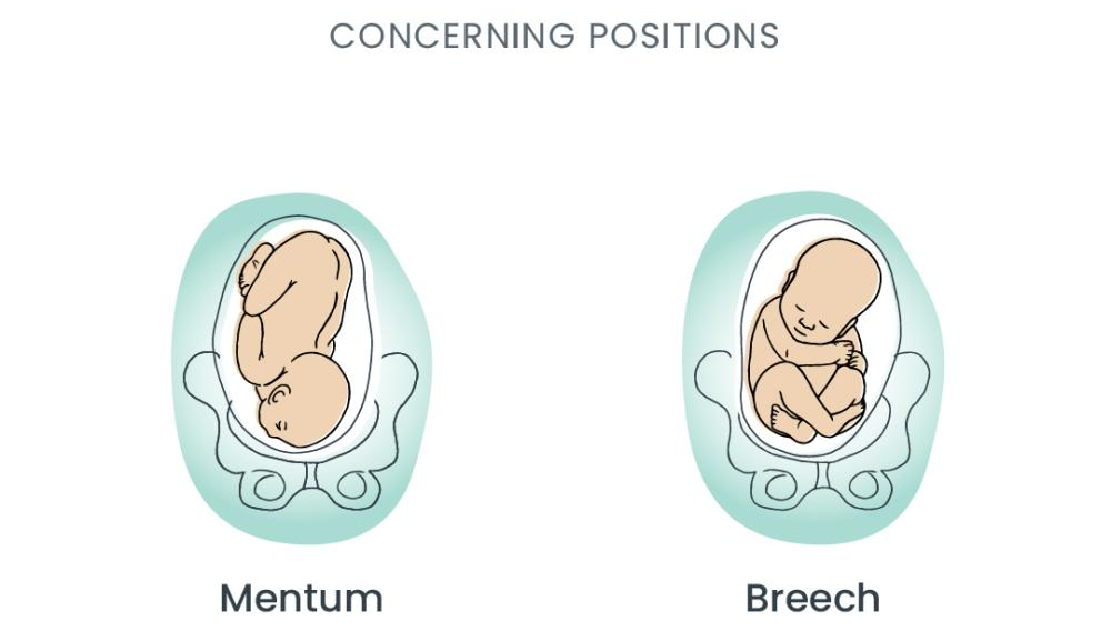 Illustration of baby in Mentum and Breech fetal birthing positions