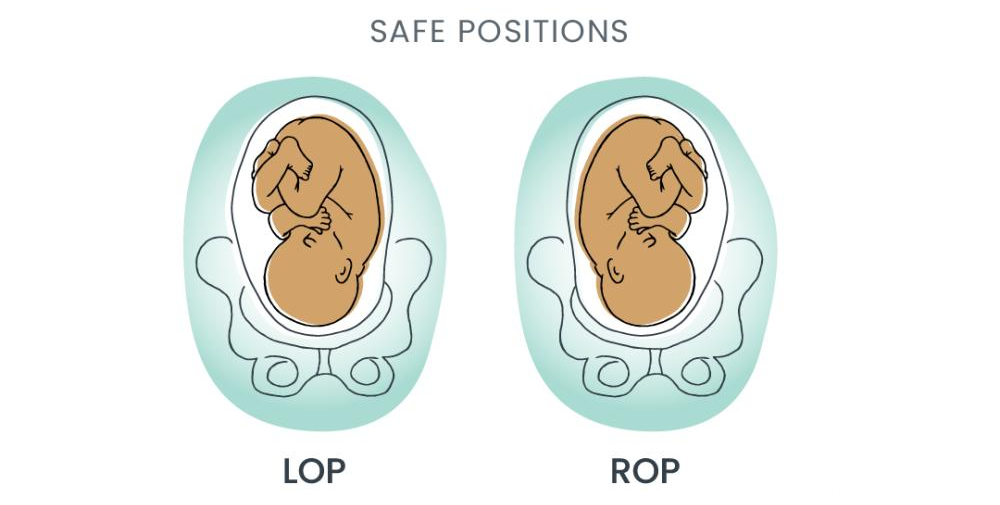 Illustration of baby in Left Occiput Posterior (LOP) and Right Occiput Posterior (ROP) fetal birthing positions