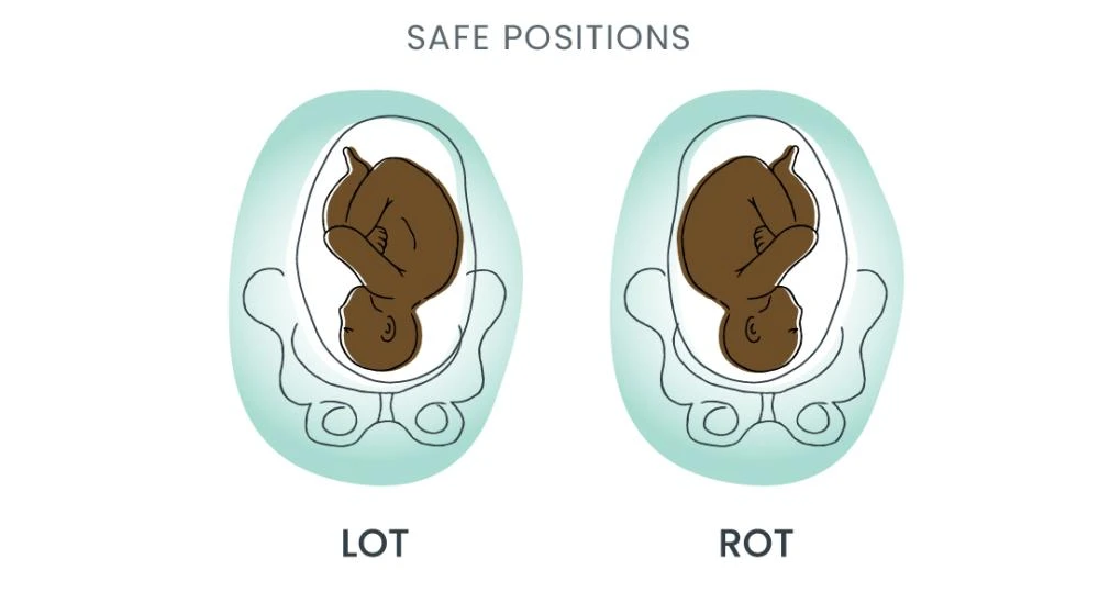 Illustration of baby in Left Occiput Transverse (LOT) and Right Occiput Transverse (ROT) fetal birthing positions