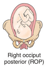 Optimizing Baby Position in Preparation for Birth