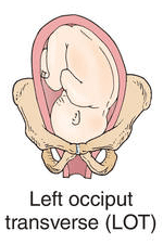 Optimizing Baby Position in Preparation for Birth