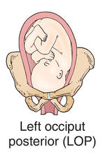 Optimizing Baby Position in Preparation for Birth