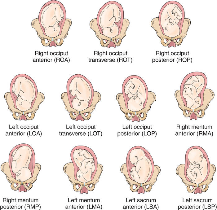 cephalic presentation vs sunny side up