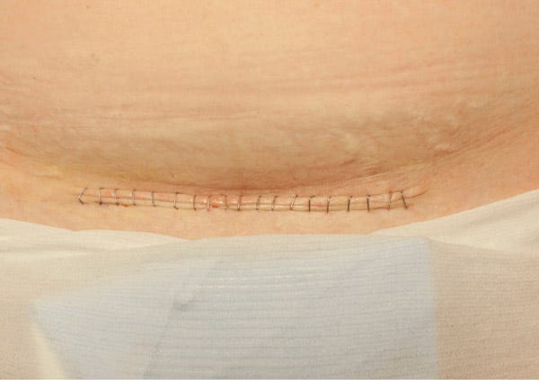 How To Take Care Of Stitches After C Sec Delivery
